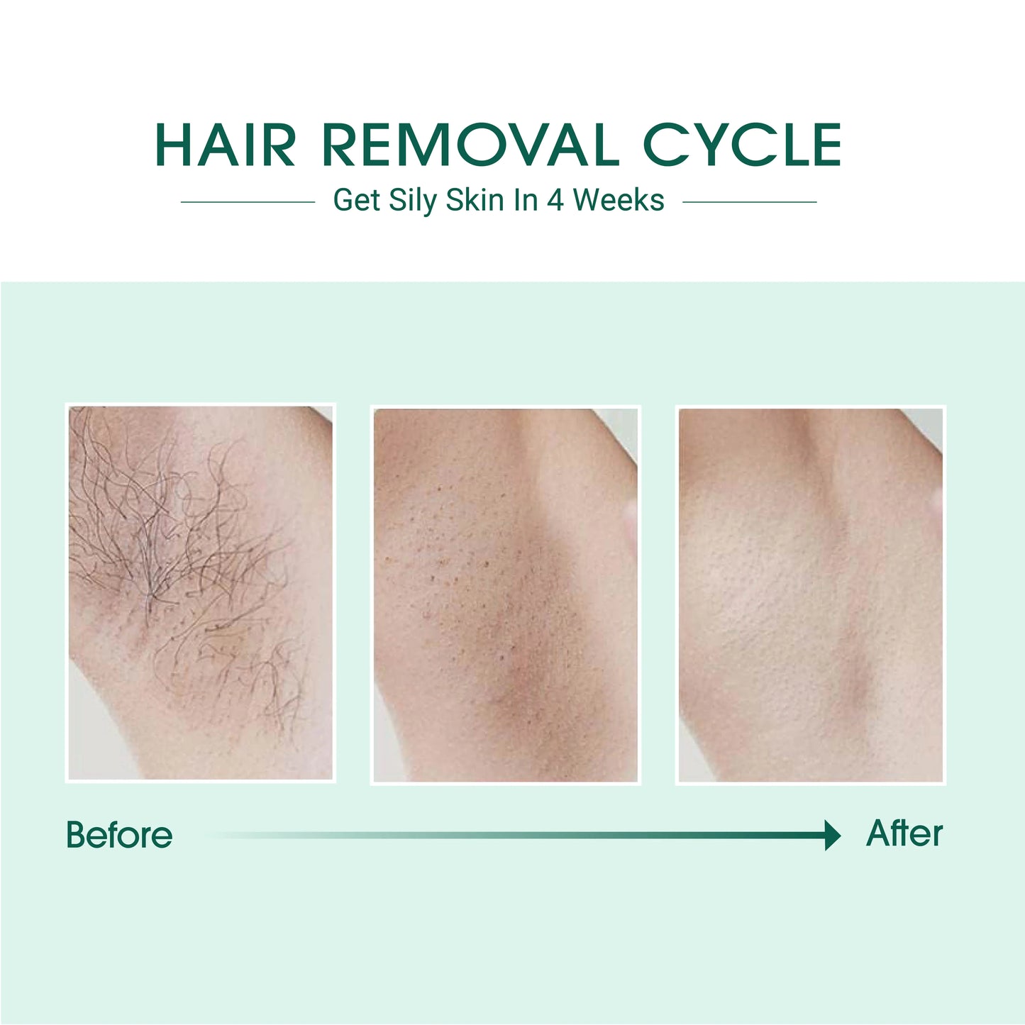 Épilation Laser IPL
